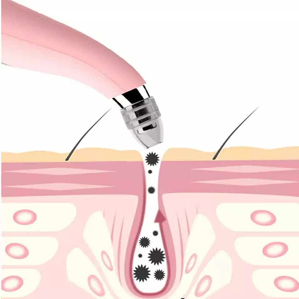 Liposuction device - جهاز شفط الدهون